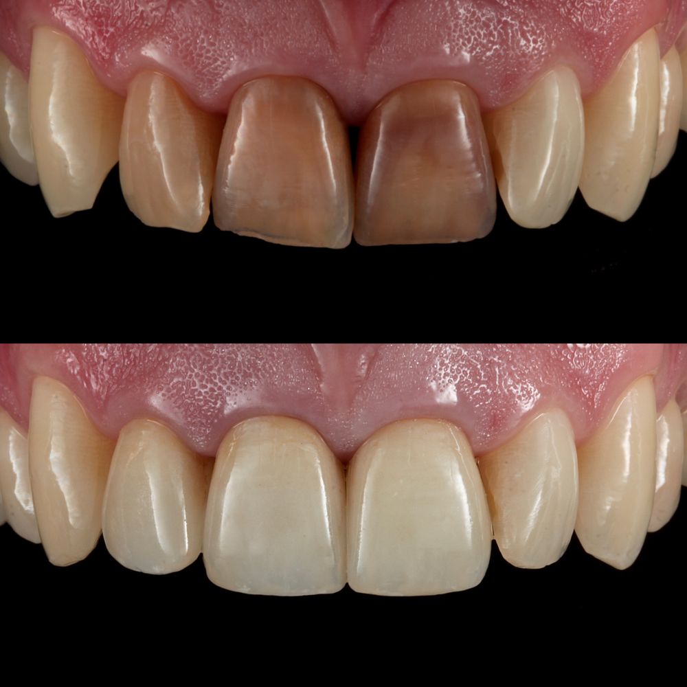 Fixing Discolored teeth with Ceramic Crowns. Before on top and after below.