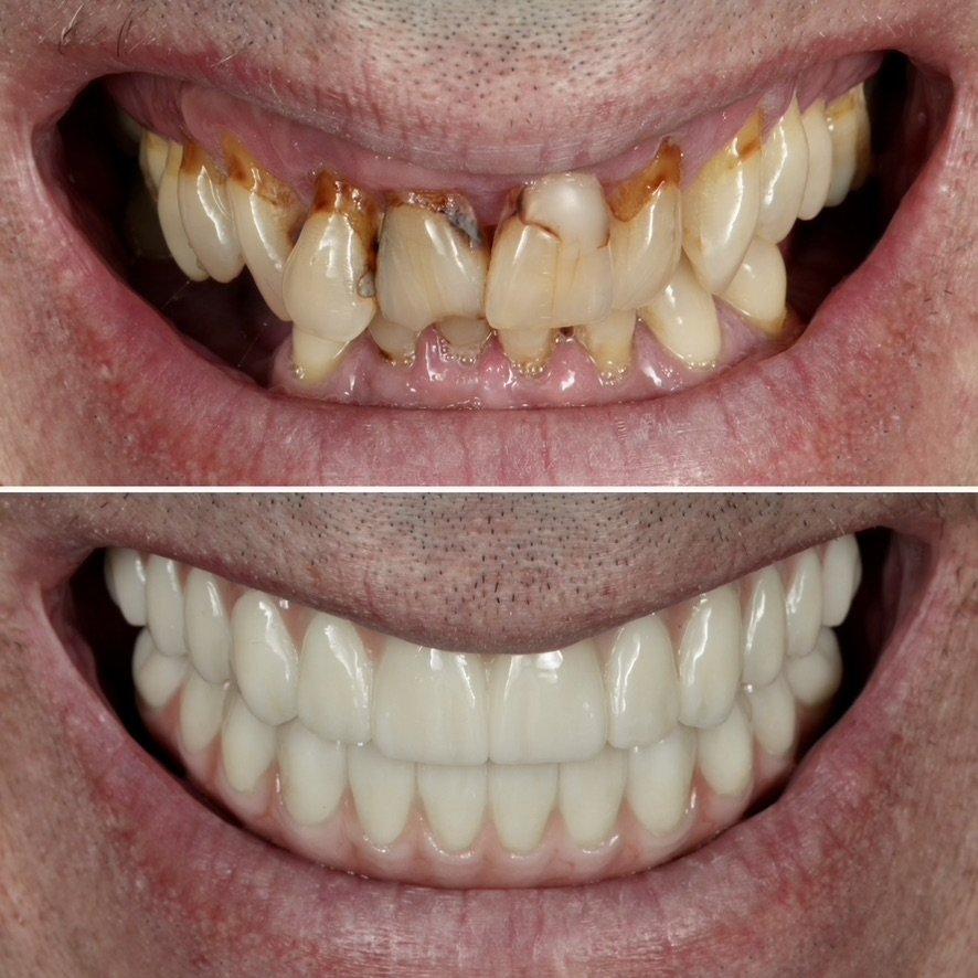 Full Mouth Reconstruction with Full Arch Implant Fixed Bridge. Before on top and after below.