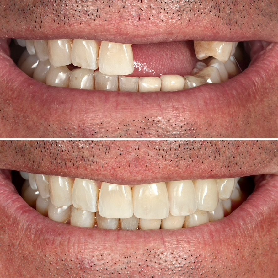 Smile Makeover using Dental Implants. Before on top and after below.