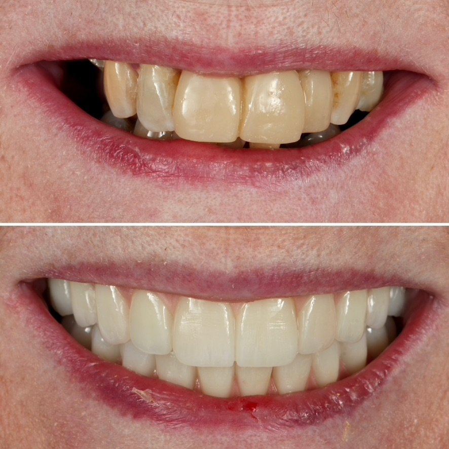 Smile Makeover with Full Arch Implant Bridges. Before on top and after below.