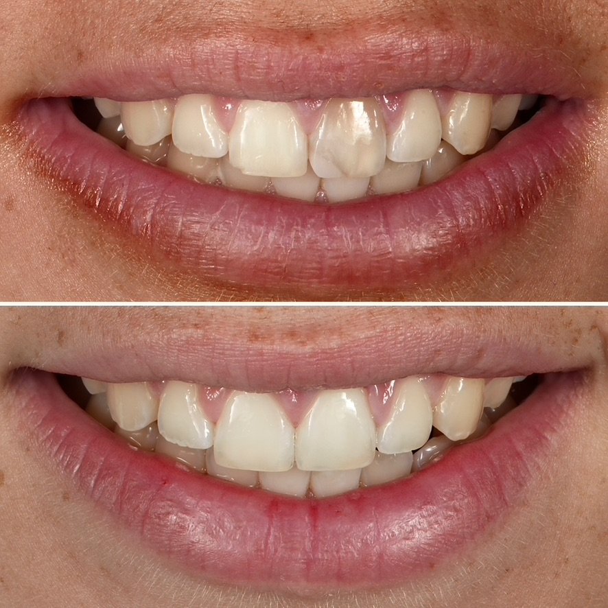 Single Tooth Matching with Porcelain Veneer. Before on top and after below.