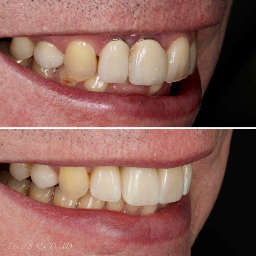 Smile Makeover with Ceramic Crowns. Before on top and after below.
