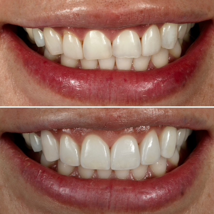 Smile Makeover with Porcelain Veneers. Before on top and after below.