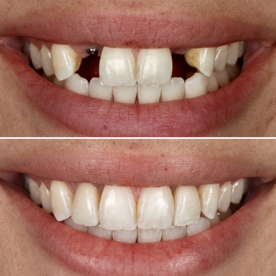 Replace missing space with Implant Crowns. Before on top and after below.