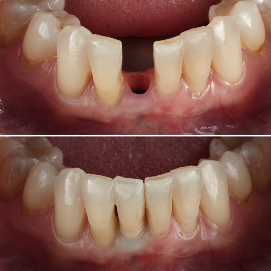 Replacing a missing tooth with Implant Crown. Before on top and after below.