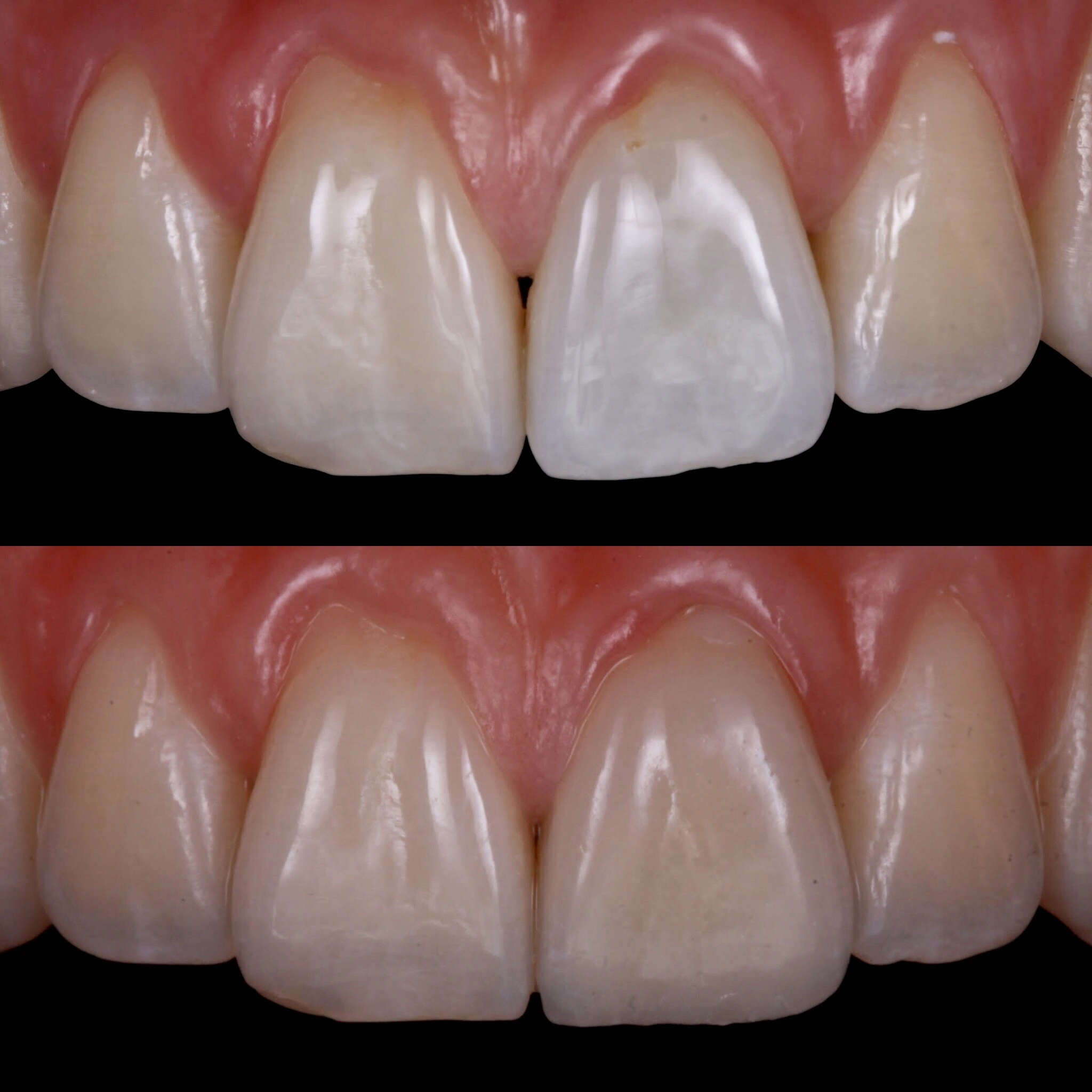 Color matching with porcelain veneer. Before on top and after below.