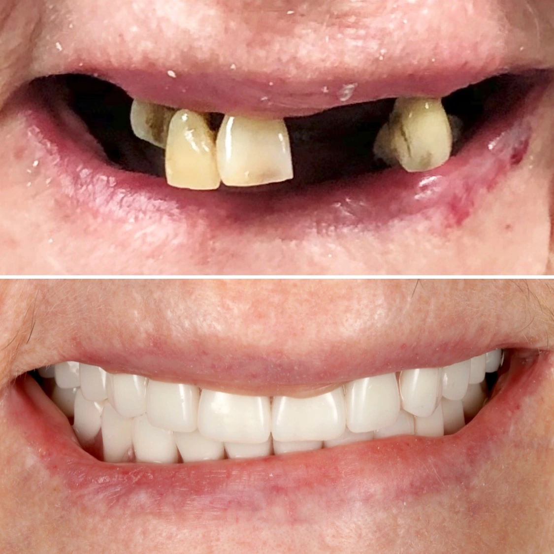 Changing a smile with removable dentures. Before on top and after below.
