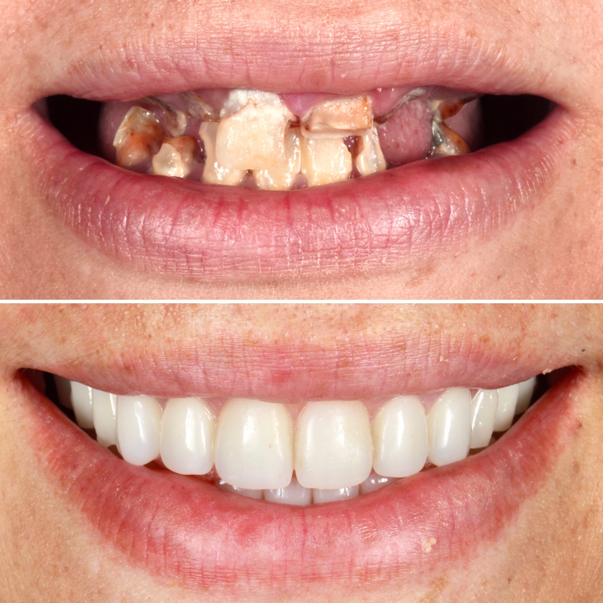 Complete transformation with removable dentures. Before on top and after below.