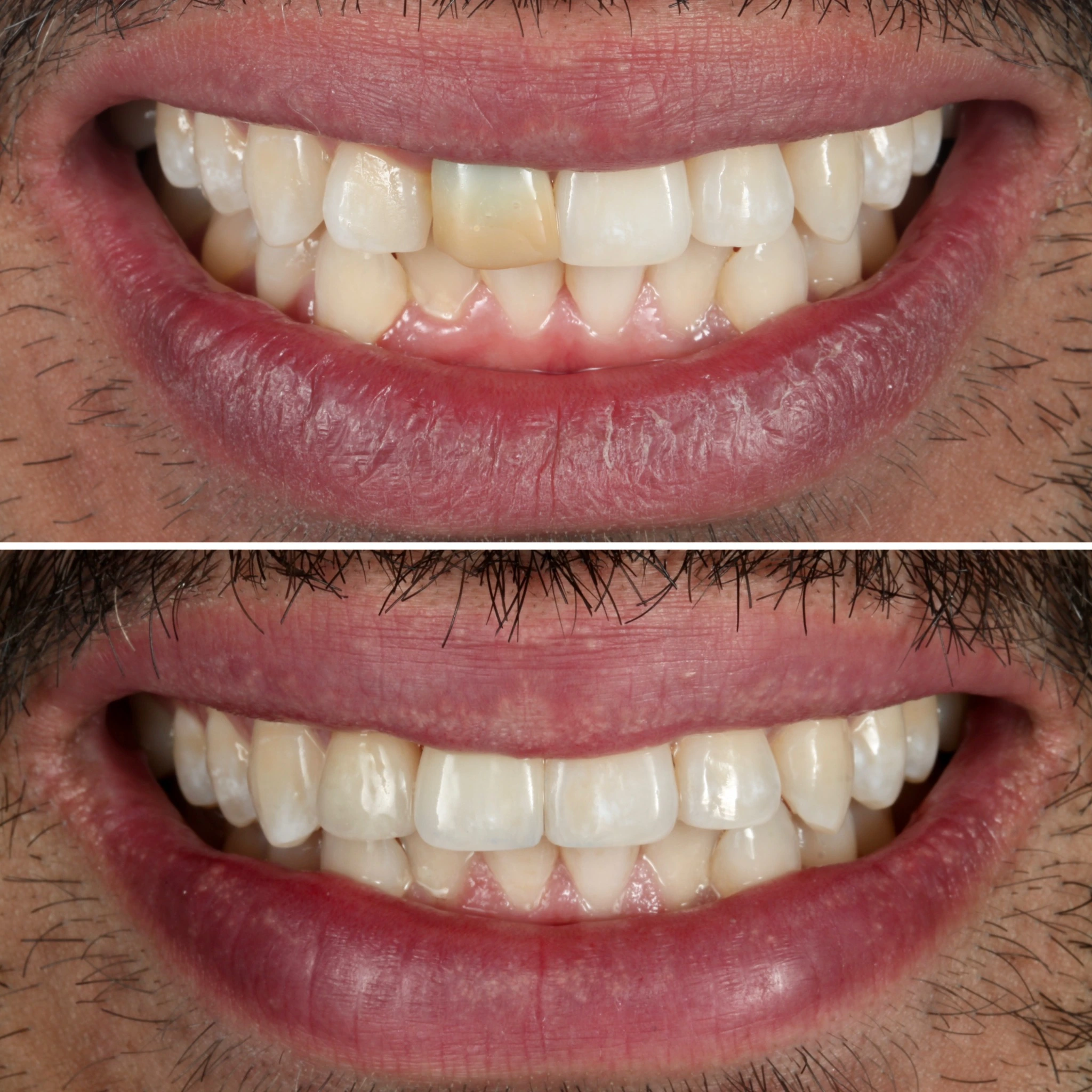 Fixing discolored teeth with ceramic crowns. Before on top and after below.