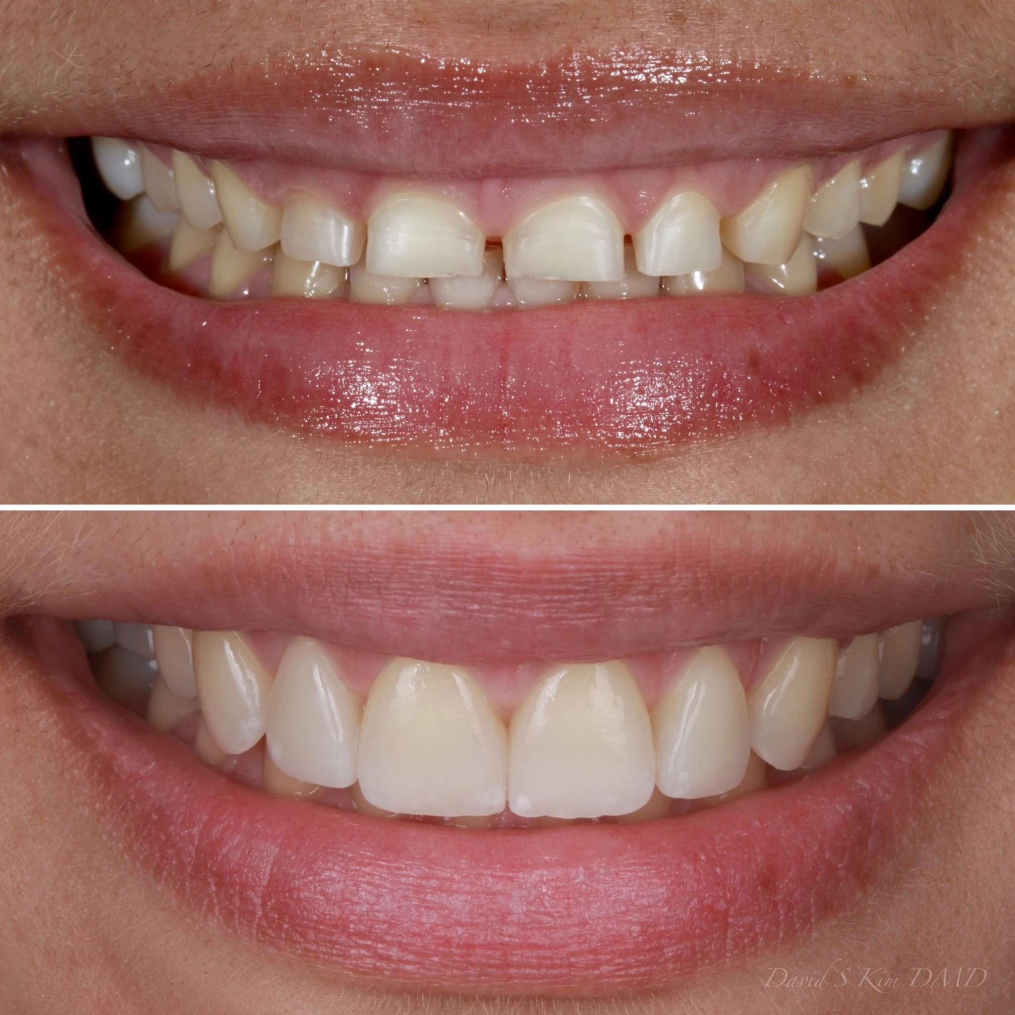 Smile makeover with porcelain veneers. Before on top and after below.