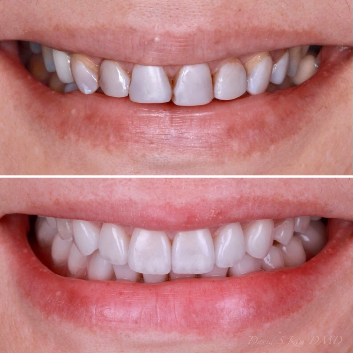 Full mouth reconstruction to improve shape, esthetics, and bite. Before on top and after below.