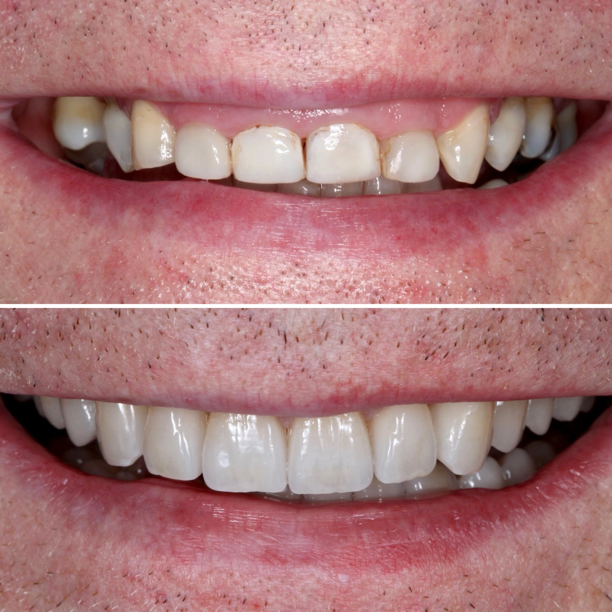 Full mouth reconstruction to improve the overall smile and bite. Before on top and after below.