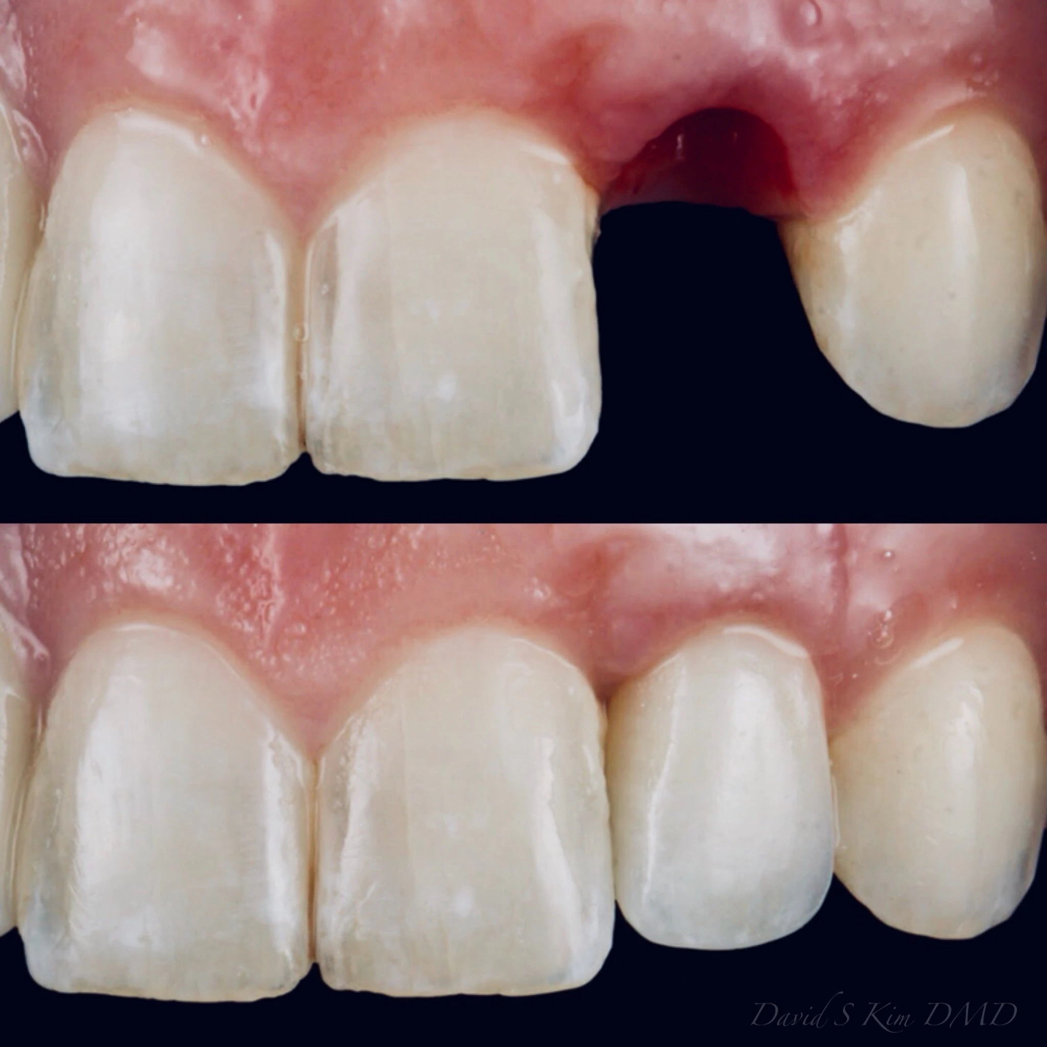 Replacing a missing tooth with an implant crown. Before on top and after below.