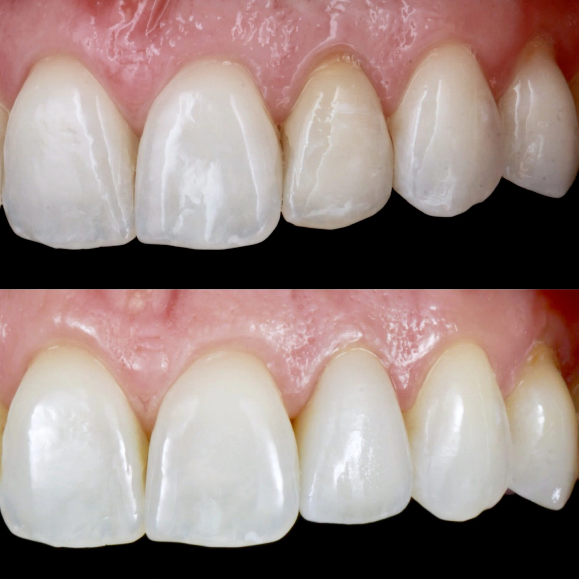 Color matching with porcelain veneer. Before on top and after below.