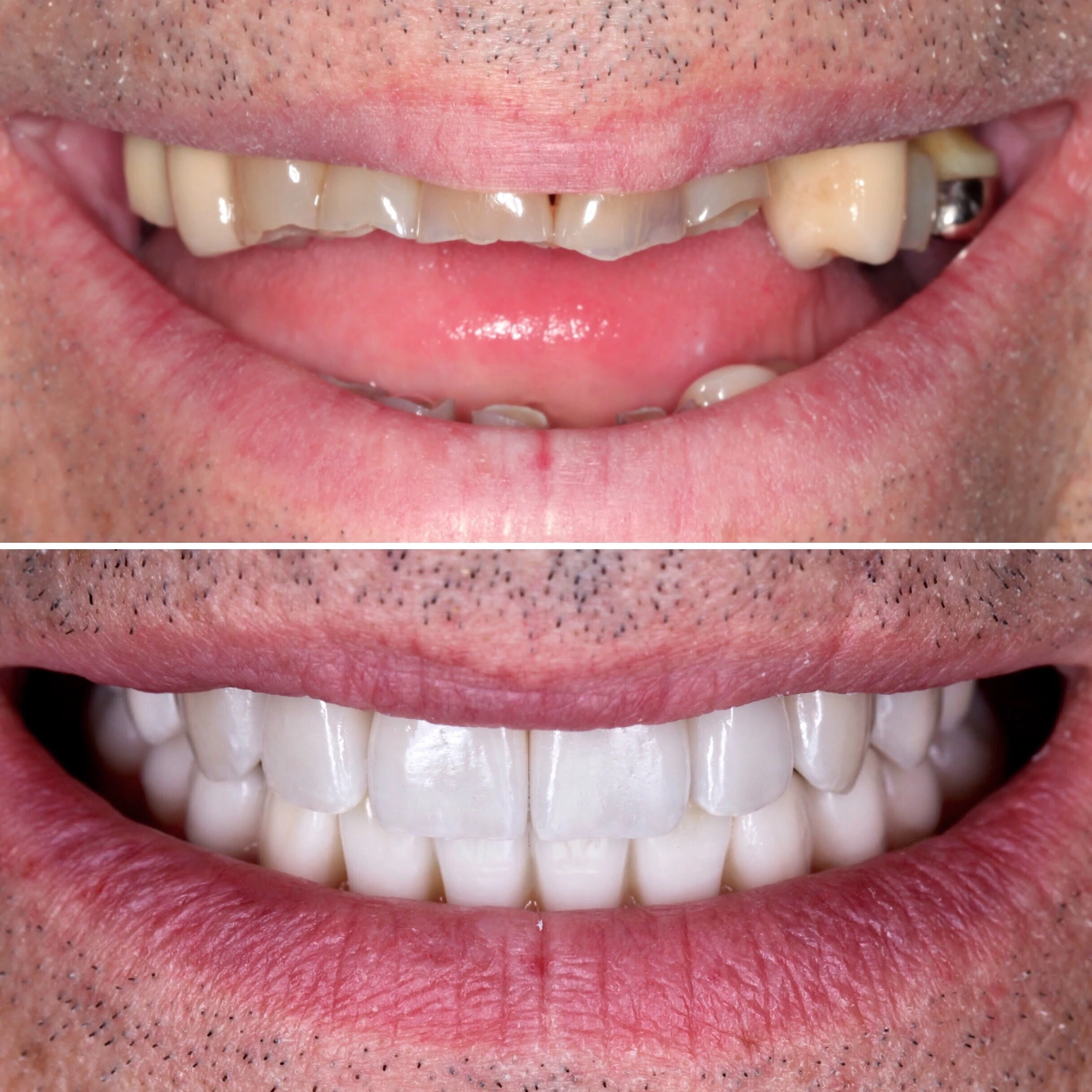 Full mouth reconstruction for a complete transformation. Before on top and after below.