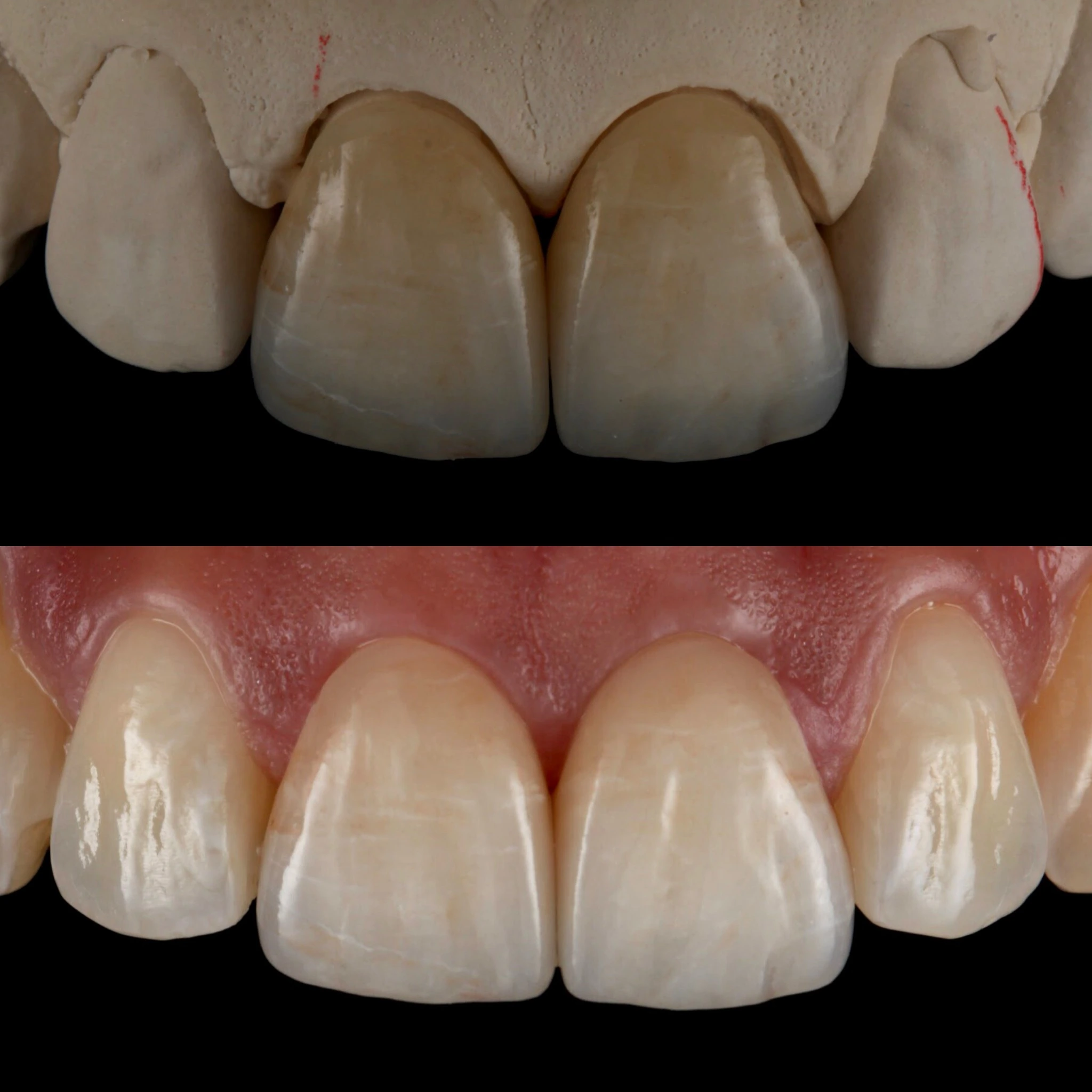 Natural result using porcelain crowns. Porcelain crowns on a model above and the result below.