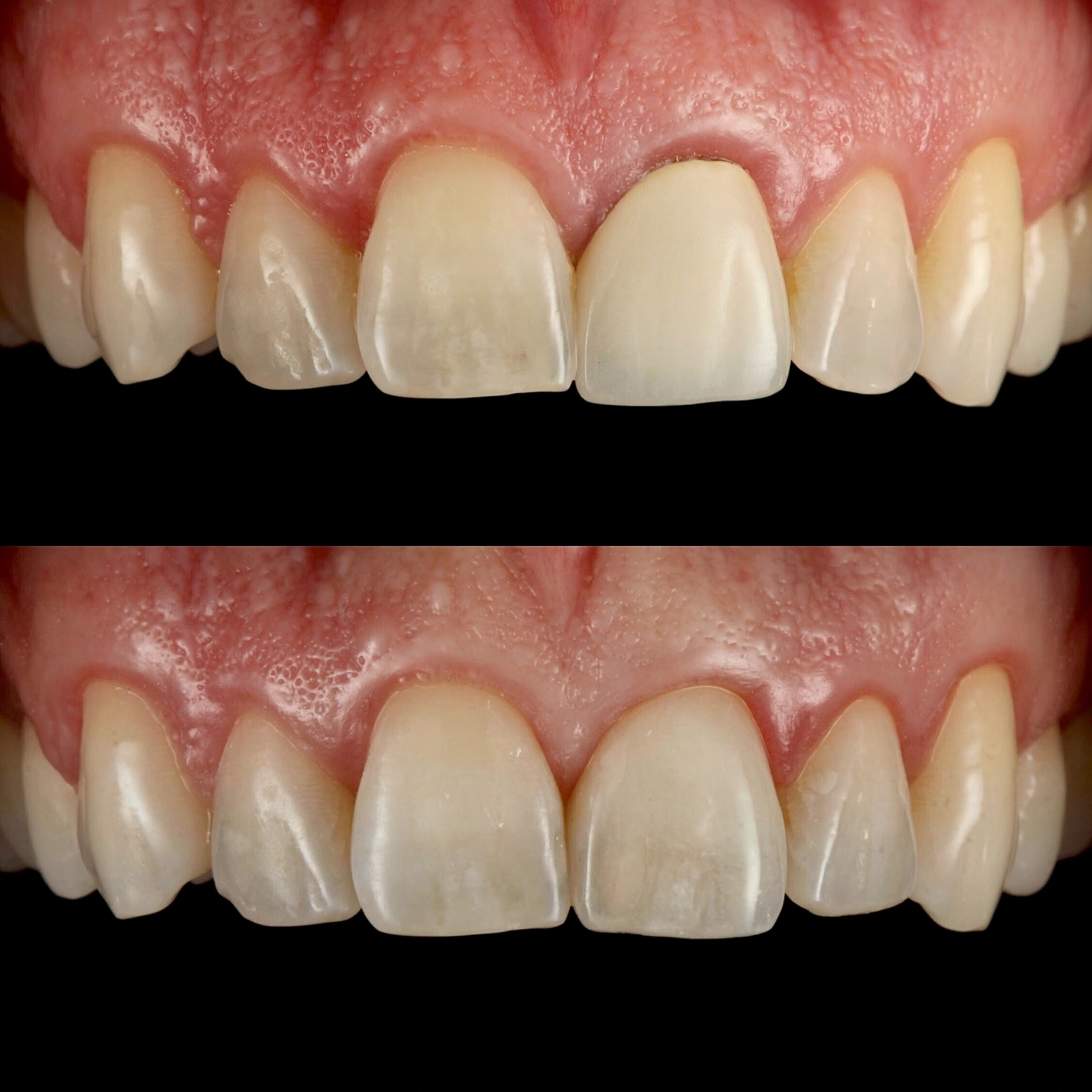 Replacing an old crown with a matching porcelain crown. Before on top and after below.