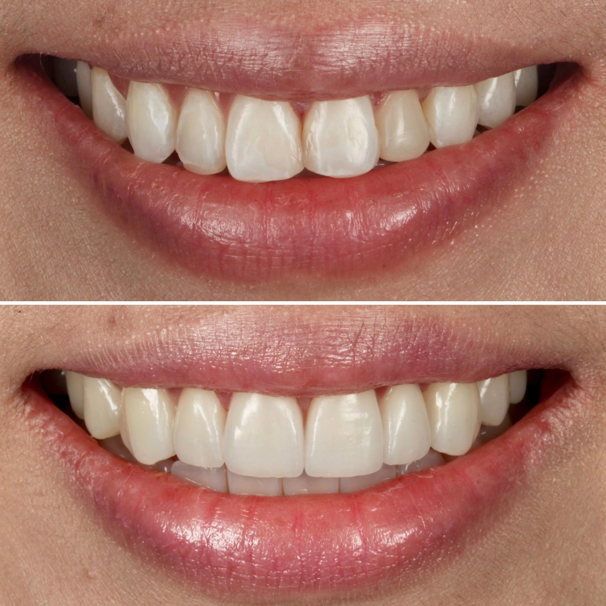 Smile makeover with ceramic crowns. Before on top and after below.