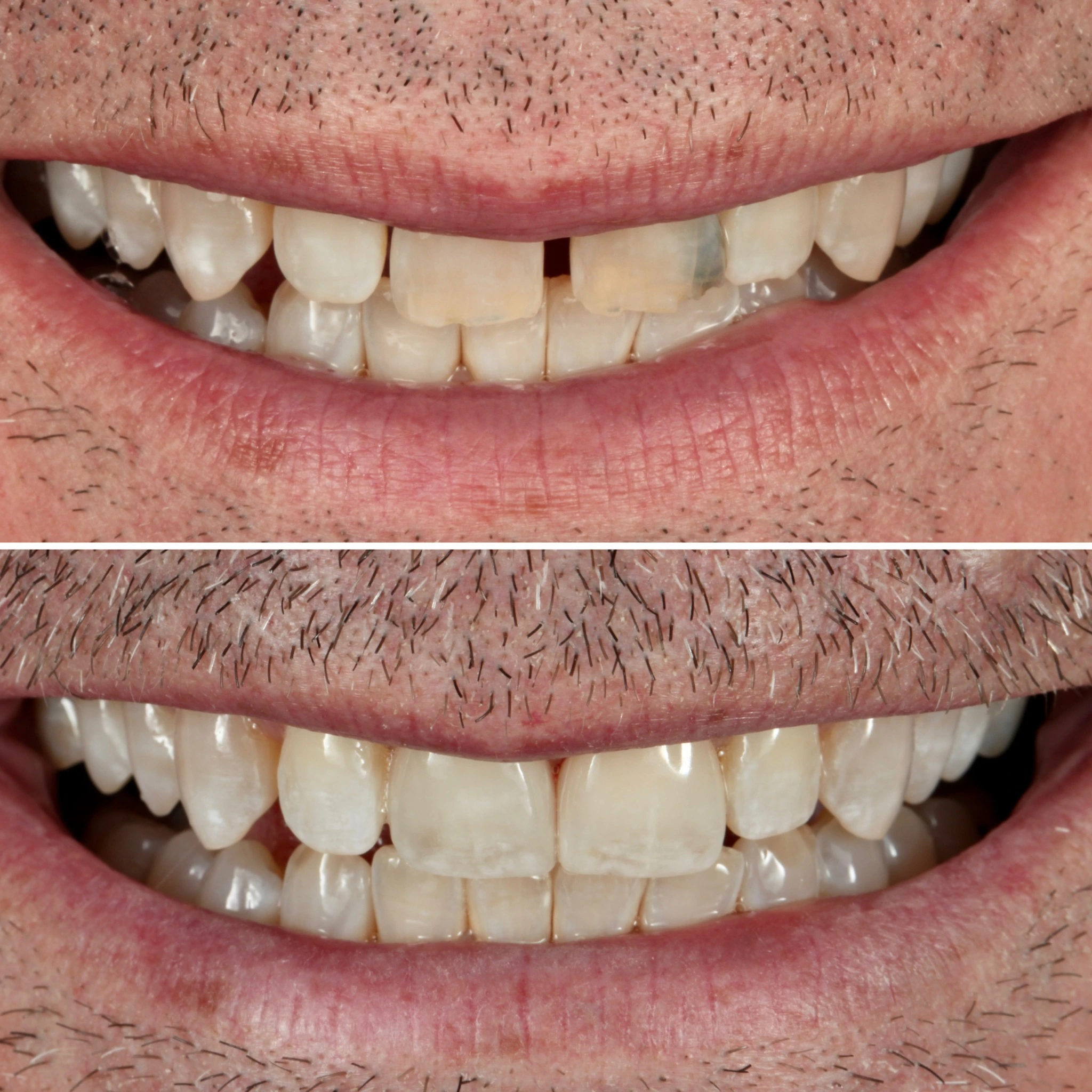 Improvement in smile with porcelain veneers. Before on top and after below.