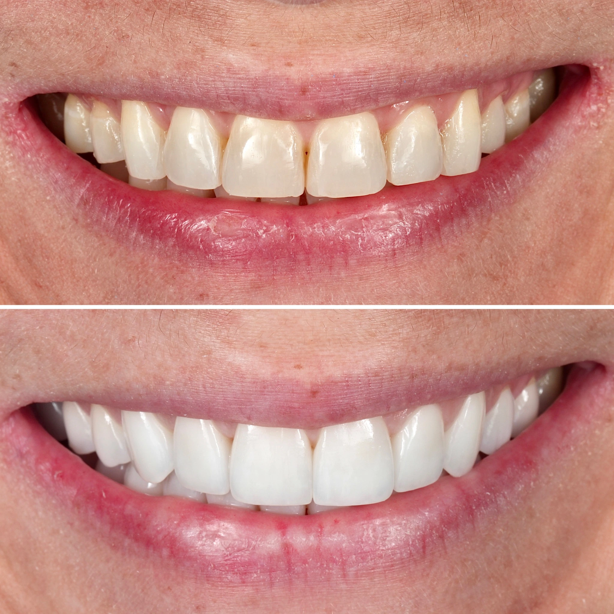 Smile makeover with bite improvement. Before on top and after below.