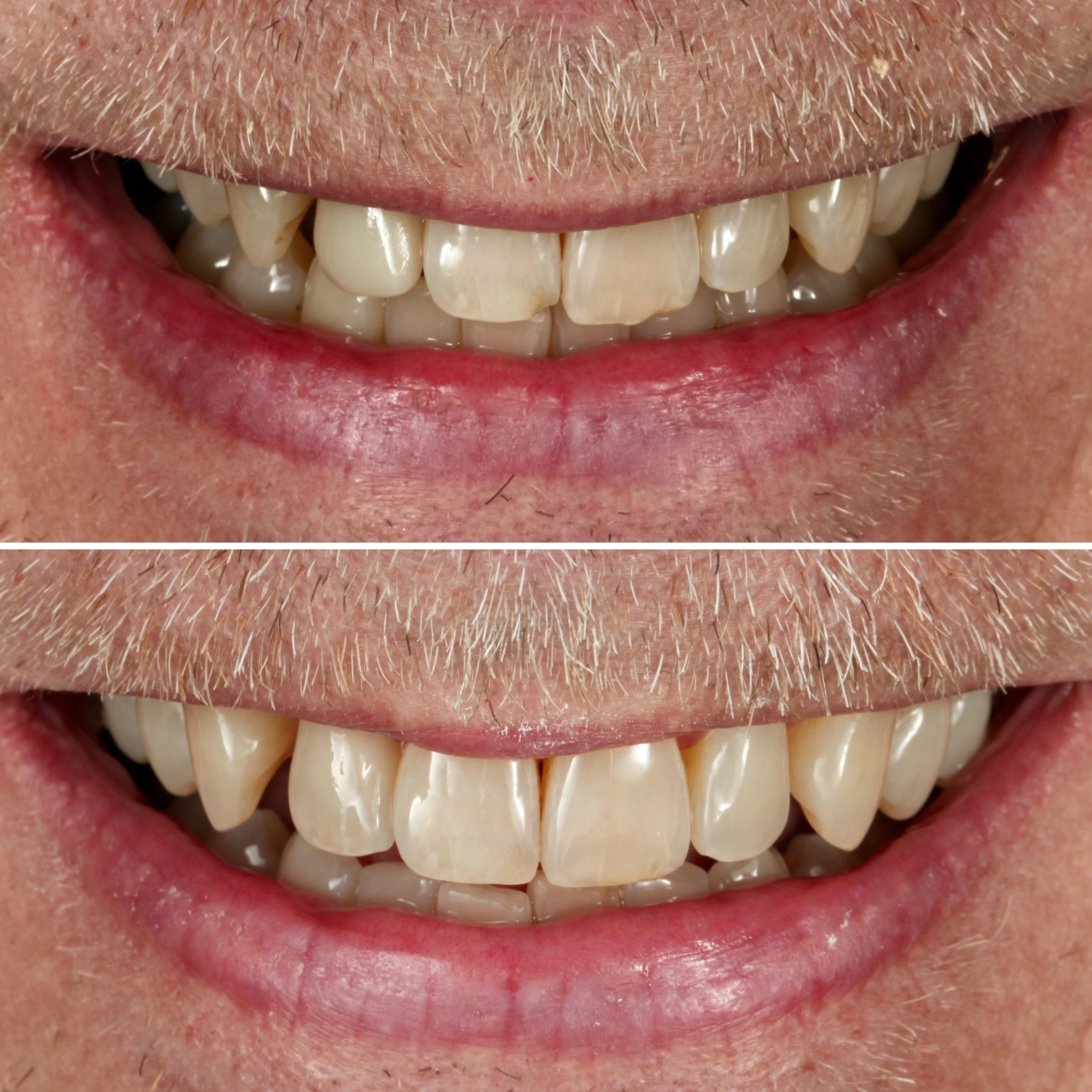Fixing chipped teeth using composite tooth-colored restorations. Before on top and after below.