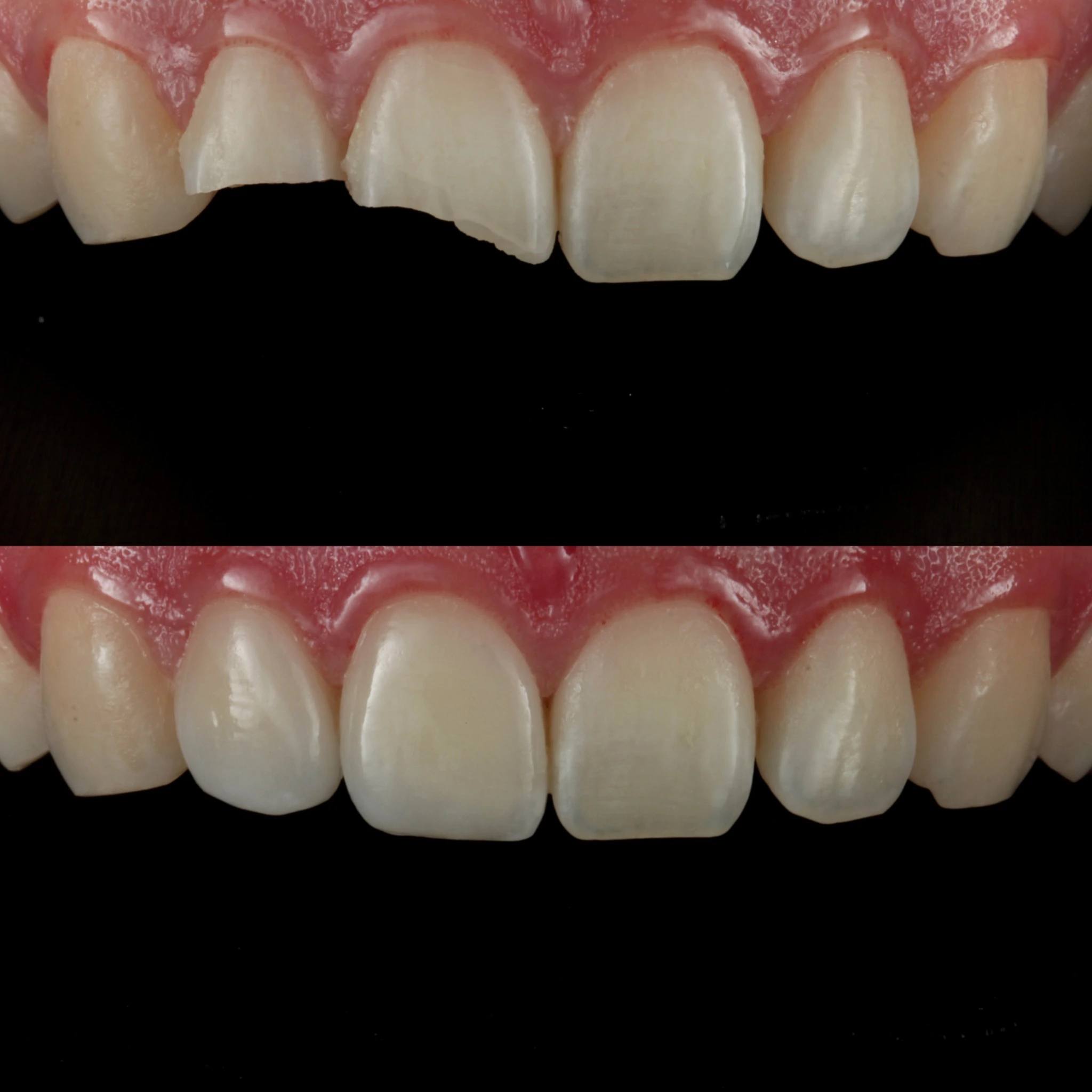 Fixing fractured teeth using porcelain veneers. Before on top and after below.