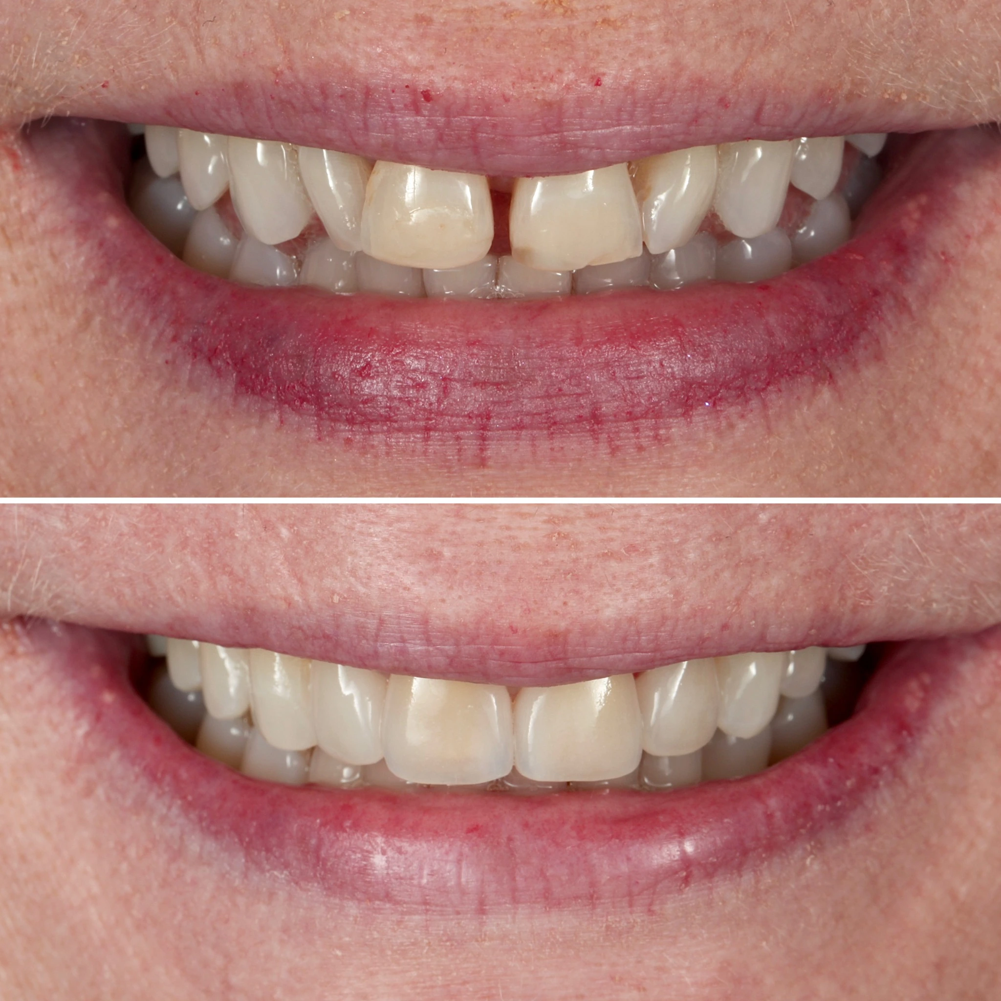 Fixing a gap with porcelain veneers. Before on top and after below.
