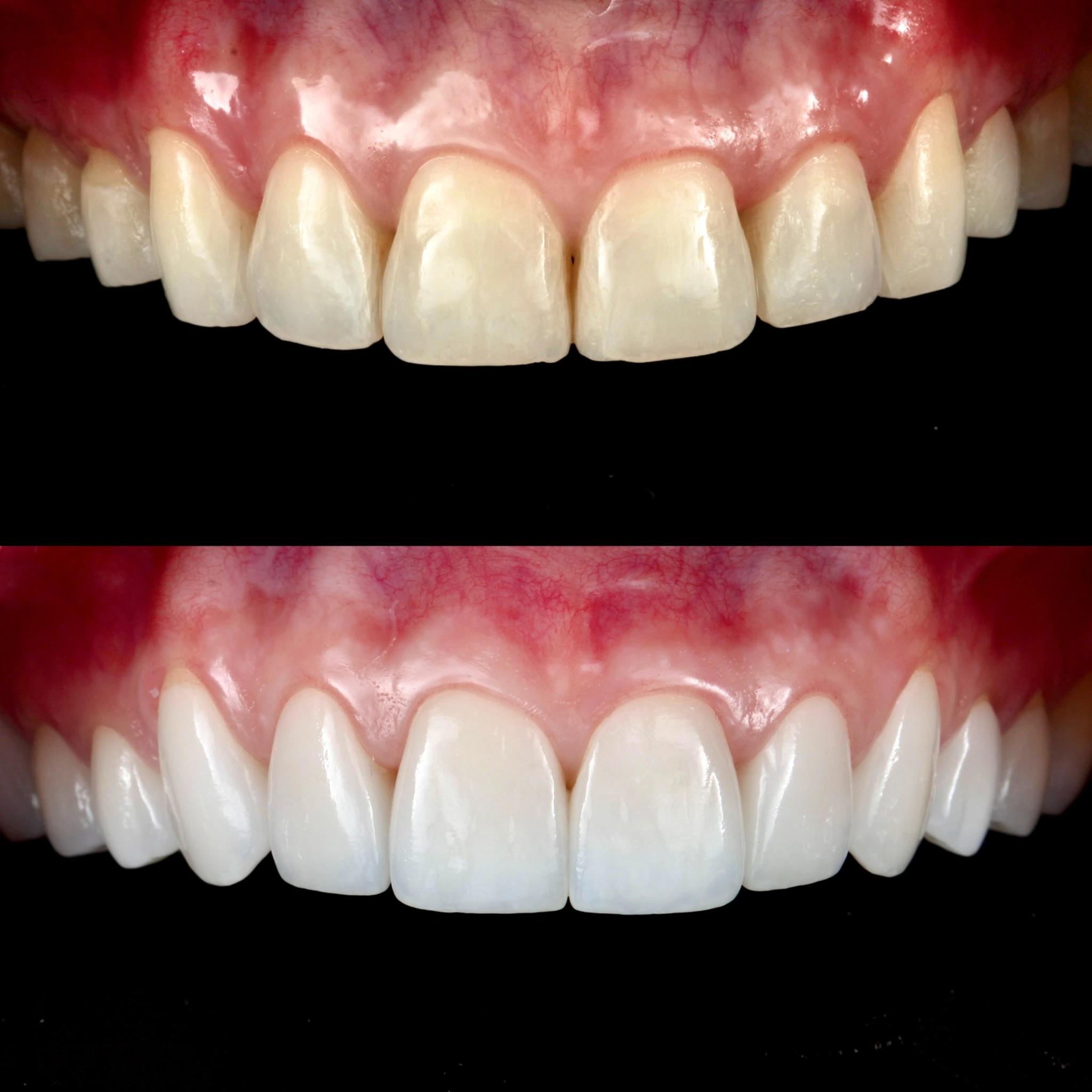 Improving color, shape, position, and alignment using porcelain veneers. Before on top and after below.