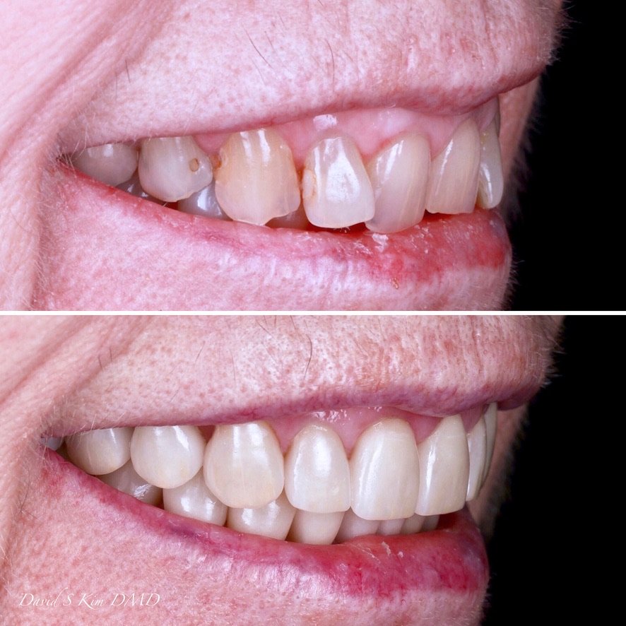 Full mouth reconstruction with ceramic crowns and veneers, before on top and after below.